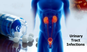 Read more about the article Infecțiile de tract urinar la bărbați: Cauze, simptome și prevenție